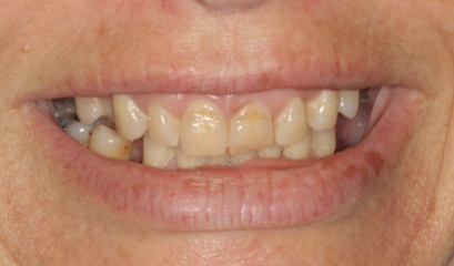 Close up of smile with missing and damaged teeth